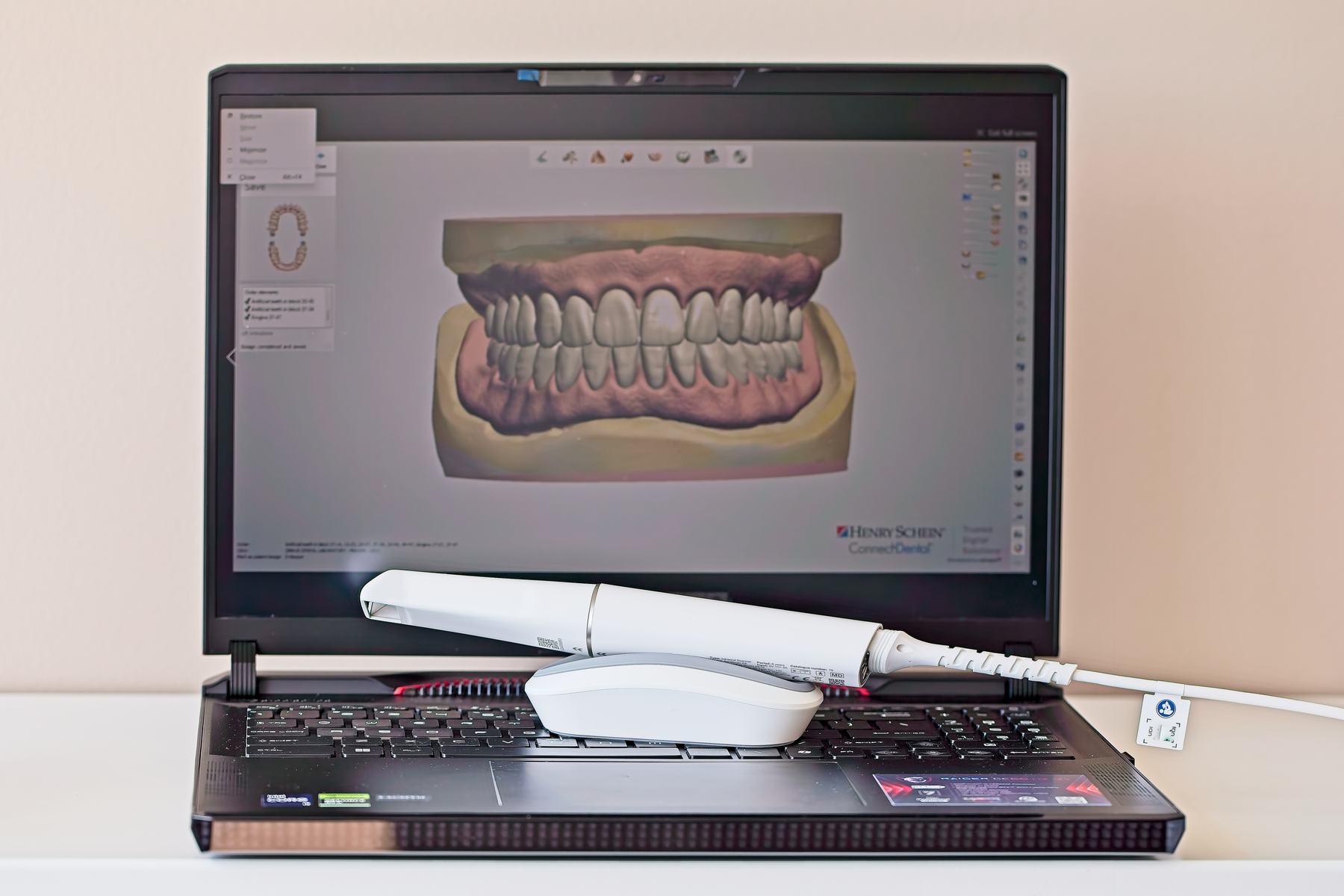 Digital denture design on a laptop